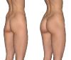 INFINI FILLER B BODY (Buttocks and body volume)
